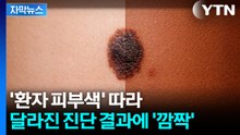 [자막뉴스] '어두운 피부'는 잘 모른다?... 특이점 발견된 AI 진단 / YTN