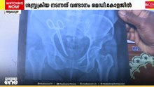വയറ്റിൽ കത്രിക കുടുങ്ങി ; ശസ്ത്രക്രിയ നടന്നത് വണ്ടാനം മെഡിക്കൽ കോളജിൽ