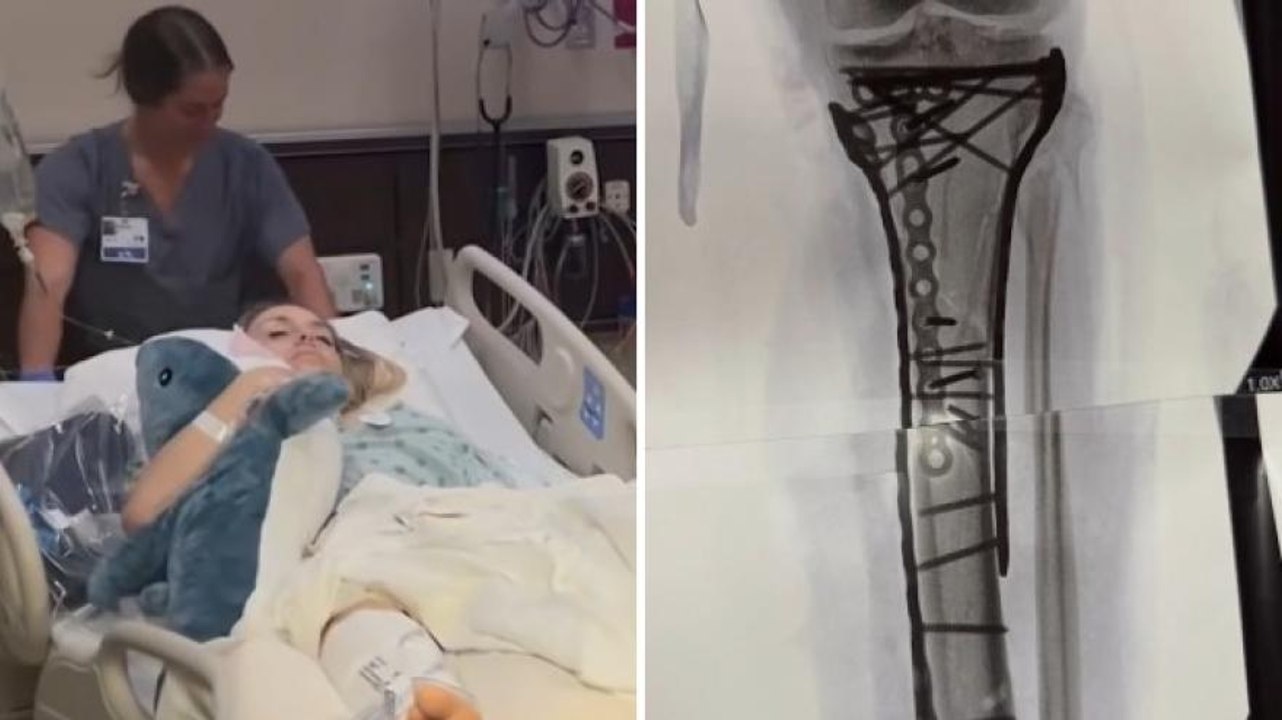 Lindsey Vonn mostra la gamba dopo l'operazione: le immagini sono impressionanti