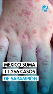 México registra 11,266 casos de sarampión: ¿Qué estados tienen más contagios y muertes?