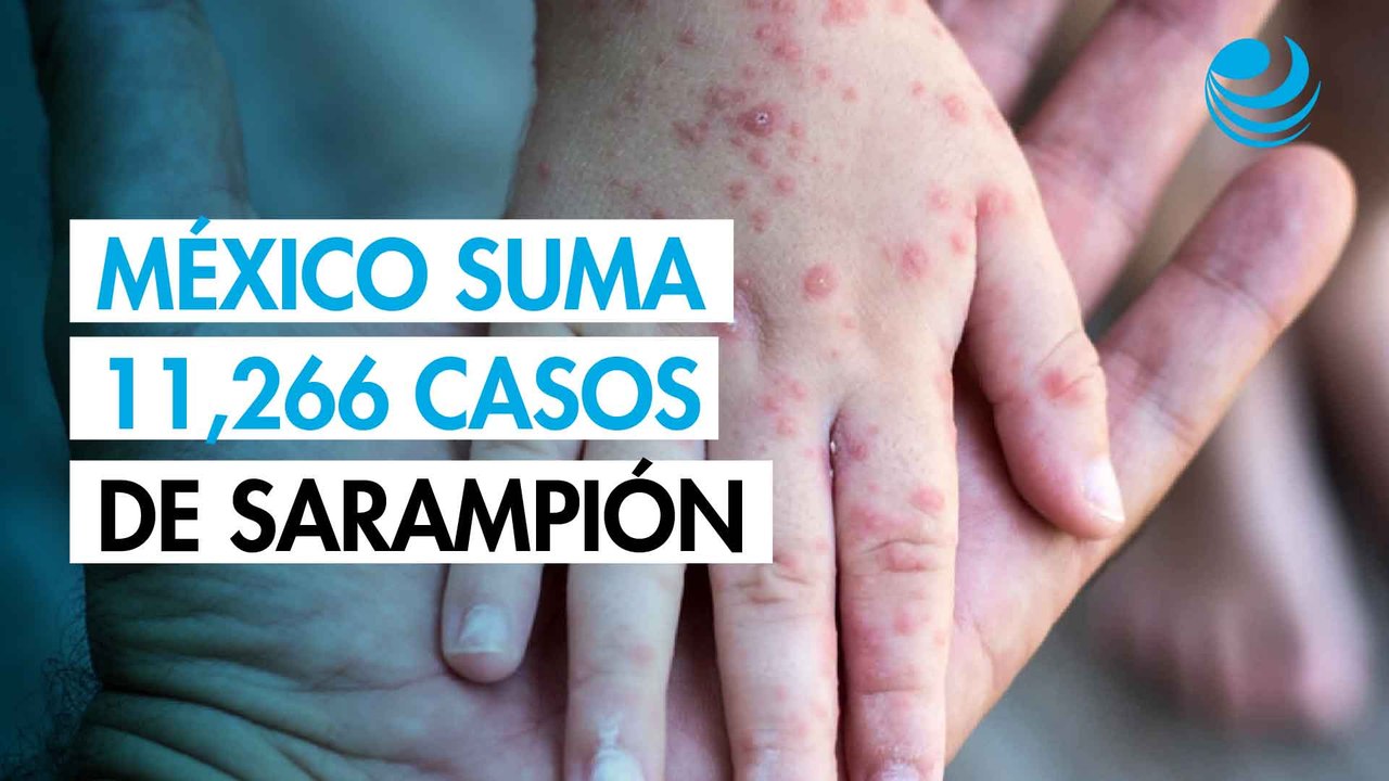 México registra 11,266 casos de sarampión: ¿Qué estados tienen más contagios y muertes?