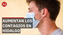 Hidago registra 12 casos de sarampión; confirman contagios en Tula y Tlaxcoapan
