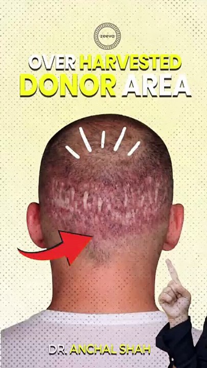 Hair transplant donor area  #haircare  #hairtransformation #zeevaclinic #donorarea