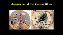 3. Screening for Congenital Heart Disease in the First _ Second Trimesters of Pregnancy