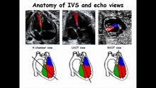 6-2 Anomalies of the Cardiac Chambers 1 Atrial Ventricular Septal Defects - YouTube