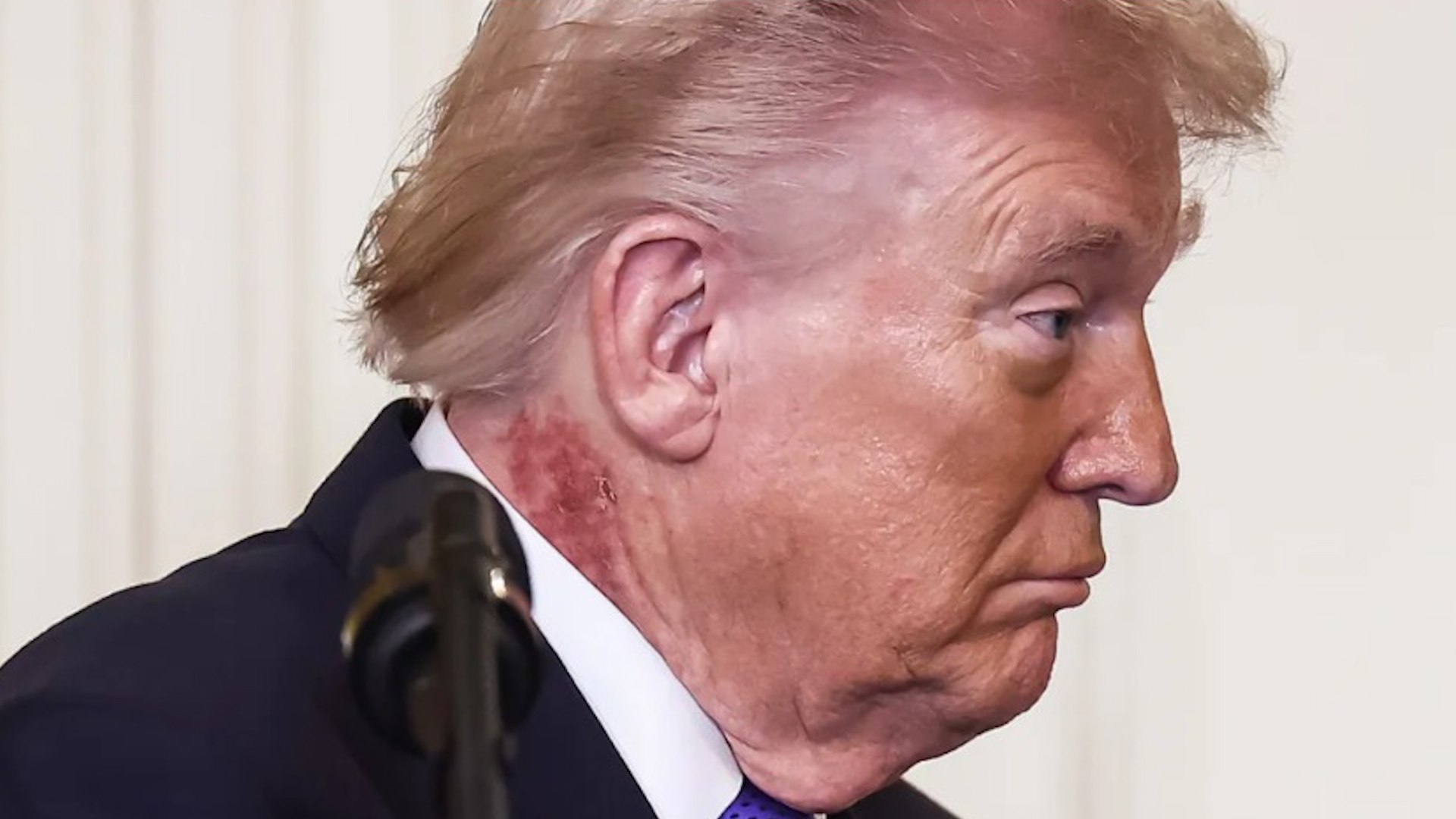 El presidente de Estados Unidos, Donald Trump, apareci� el lunes en un acto oficial celebrado en la Casa Blanca con un visible sarpullido rojizo en el cuello, lo que gener� comentarios y especulaciones. El mandatario, de 79 a�os y el m�s longevo en haber sido elegido para el cargo, mostraba una zona enrojecida con peque�as costras marron�ceas en el lado derecho del cuello, apenas por encima del cuello de la camisa, seg�n se apreciaba en una fotograf�a difundida por Agence France-Presse (AFP).
Ante las preguntas suscitadas por la imagen, el m�dico presidencial, Sean Barbabella, explic� en un comunicado enviado a AFP que el enrojecimiento se debe al uso de una crema "muy com�n" aplicada como tratamiento preventivo para la piel. De acuerdo con el parte m�dico, el producto fue recetado por el equipo sanitario de la Casa Blanca y el presidente lo est� utilizando desde hace aproximadamente una semana.
El comunicado a�adi� que este tipo de tratamiento puede provocar enrojecimiento temporal y que se espera que la irritaci�n visible persista durante algunas semanas antes de desaparecer por completo.