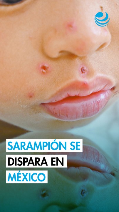 Sarampión: La importancia de la vacunación ante el repunte de contagios