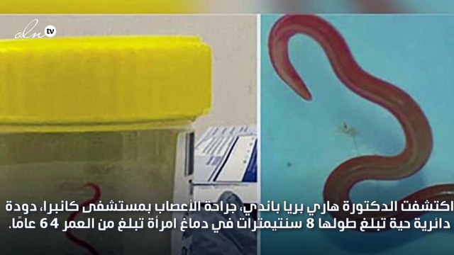 لأول مرة في العالم استخراج دودة الثعبان من دماغ سيدة