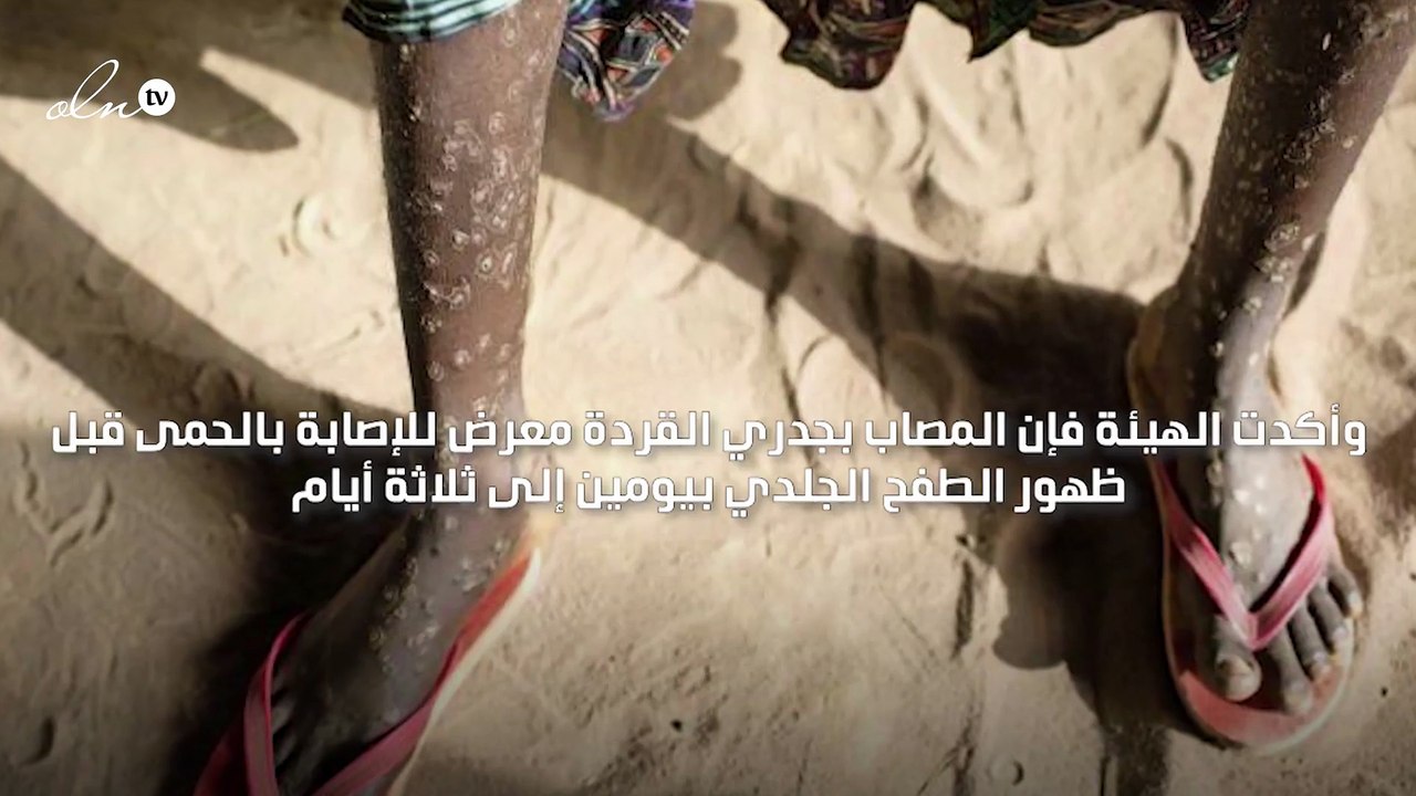 عوارض جدري القردة تختلف عن عوارض جدري الماء