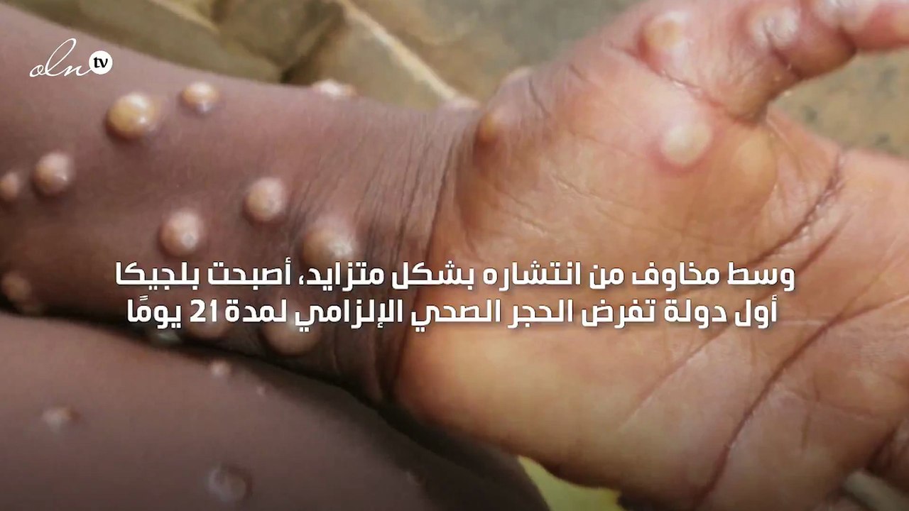 بلجيكا تفرض حجرًا صحيًا على المصابين بجدري القرود