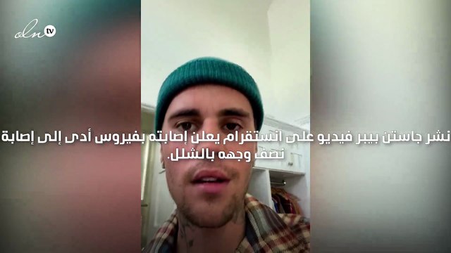 جاستن بيبر يعلن إصابته بشلل في وجهه