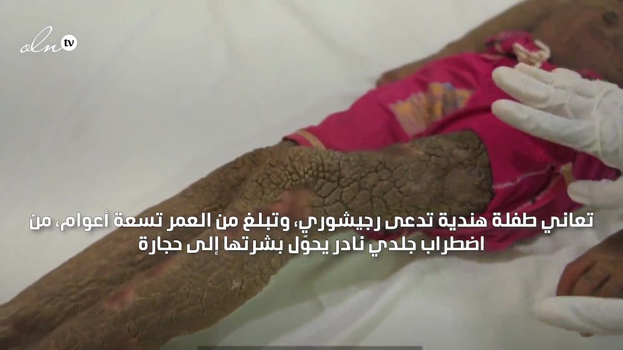 طفلة هندية تعاني من اضطراب جلدي يحول بشرتها إلى...