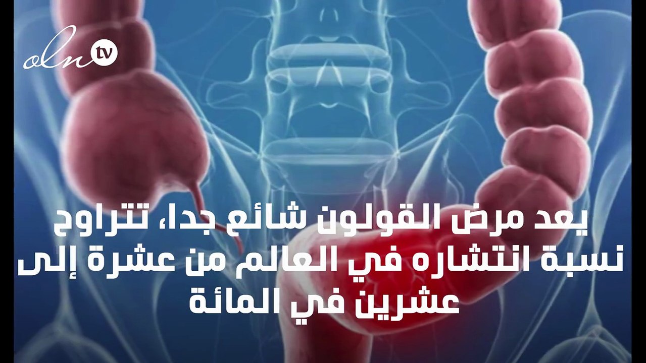 اعراض القولون