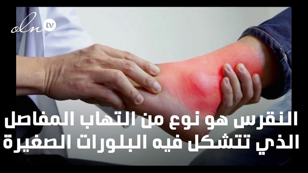 اعراض النقرس