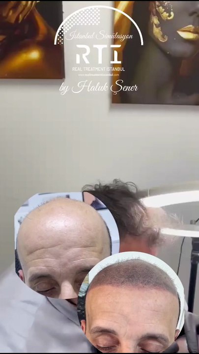 Saç Simülasyonu (Dövme Değildir) Telefon Aşağıda