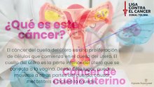 Cáncer de cuello uterino