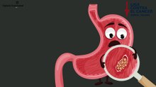 Cáncer gástrico