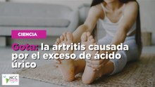 Gota: la artritis causada por el exceso de ácido úrico