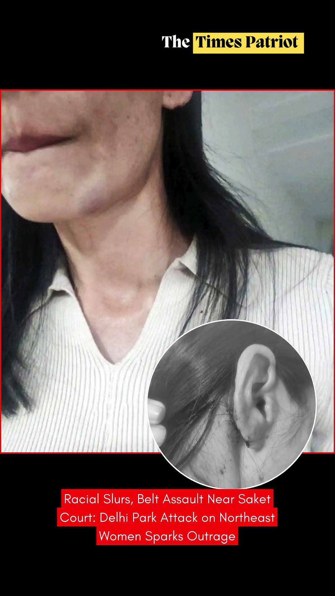 Racial Slurs, Belt Assault Near Saket Court: Delhi Park Attack on Northeast Women Sparks Outrage