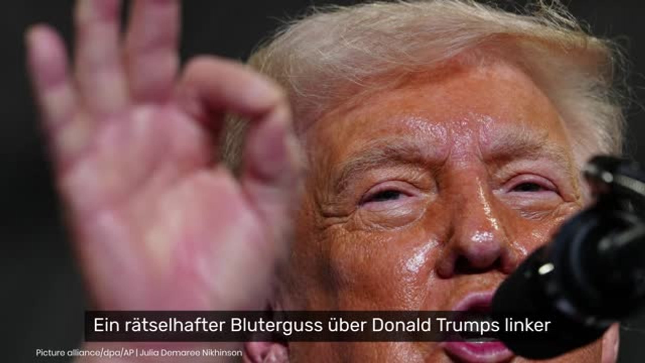 Donald Trump gestürzt?: Rätselhafter Bluterguss im Gesicht - Weißes Haus schweigt zu Trump-Verletzung