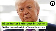 Donald Trump gestürzt?: Rätselhafter Bluterguss im Gesicht - Weißes Haus schweigt zu Verletzung