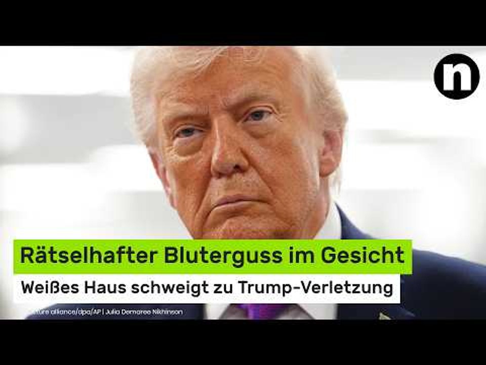 Donald Trump gestürzt?: Rätselhafter Bluterguss im Gesicht - Weißes Haus schweigt zu Verletzung