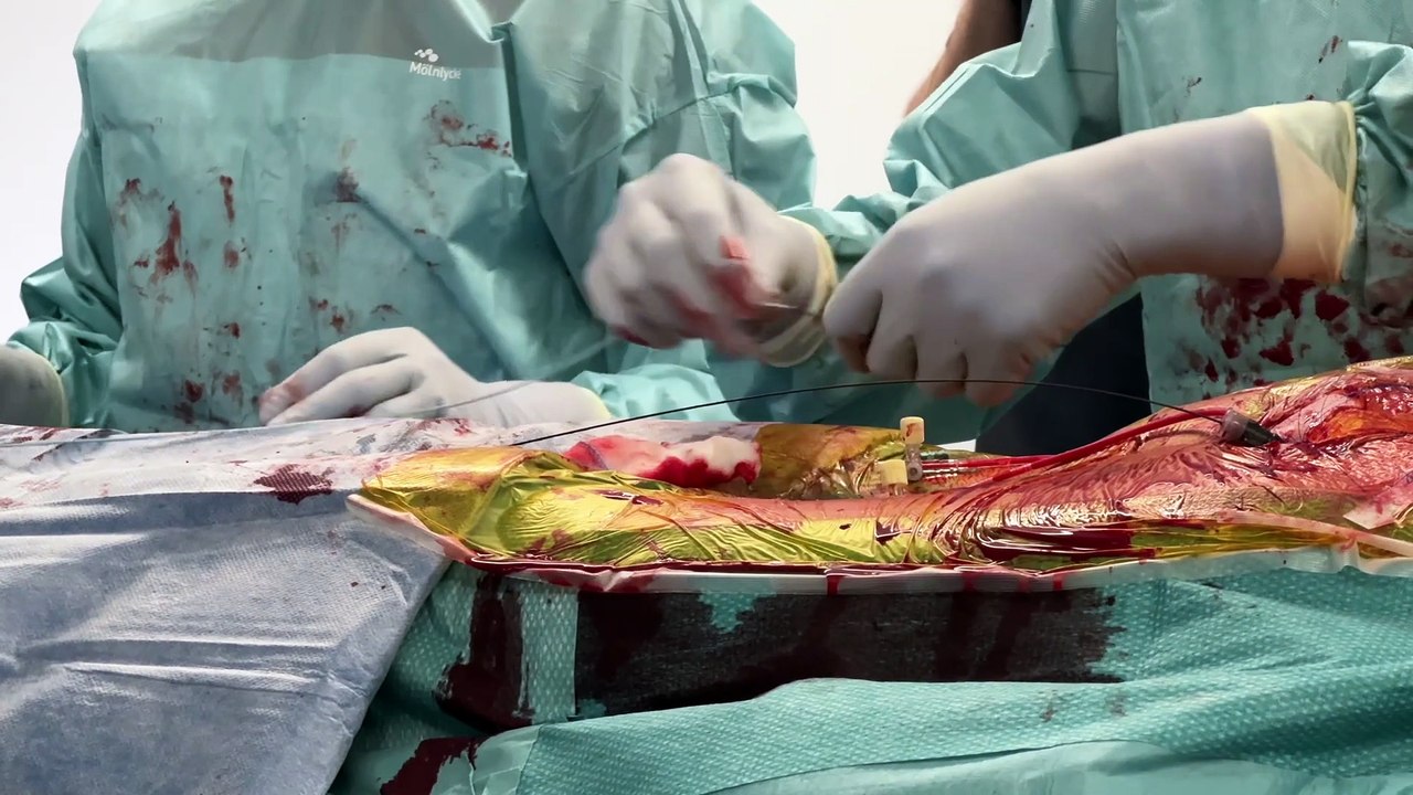 À Saint-Étienne, la clinique mutualiste modernise sa salle hybride