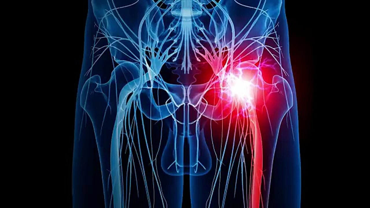 علاج ألم وتنميل المؤخرة والرجل بتمرين واحد فقط _ عرق النسا الكاذب