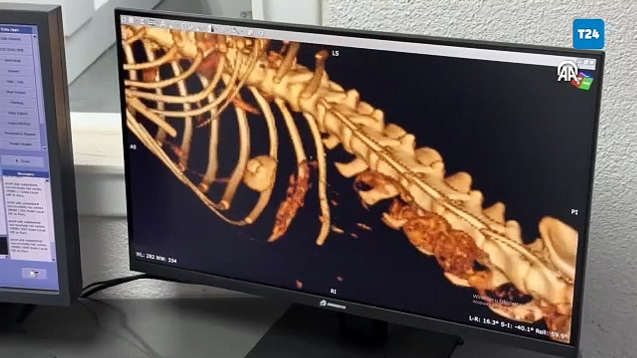 Zonguldak'ta kedinin yuttuğu vakumlu tutucu endoskopiyle çıkarıldı
