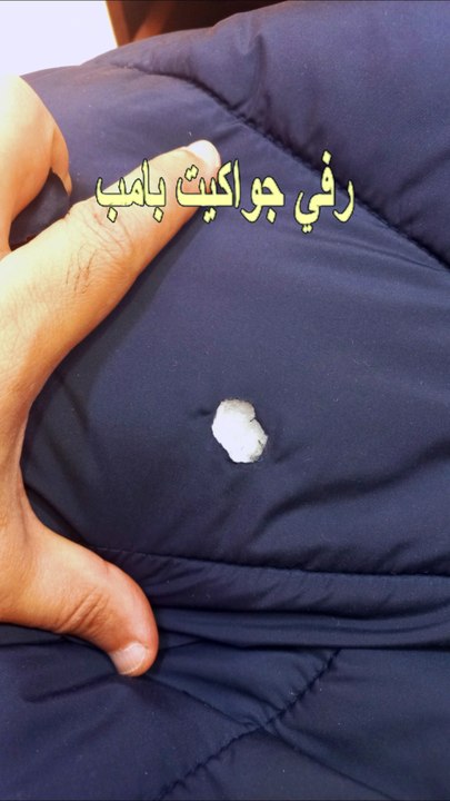 Different sizes of holes can be treated.