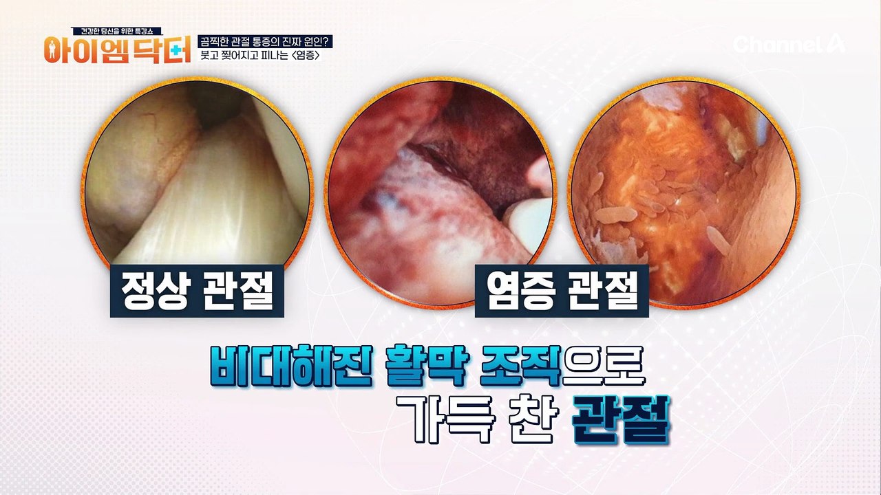 잦은 음주와 기름진 음식을 찾았던 사연자! 몸속 염증을 쌓이게 한 원인이 되었다