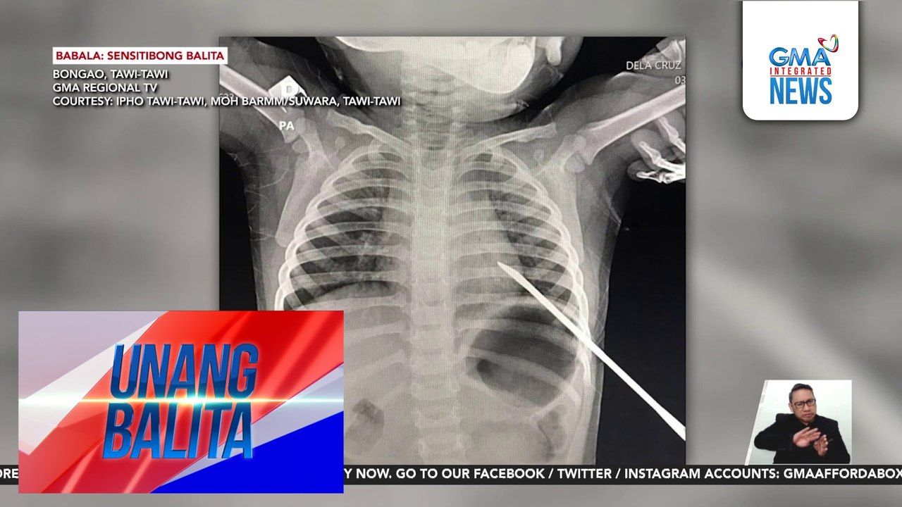 Isang taong gulang na bata, natusok ng nail pusher sa dibdib habang naglalaro; ligtas na matapos operahan | Unang Balita