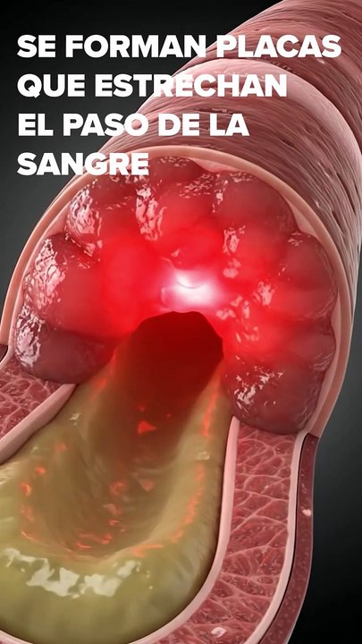 El colesterol alto no avisa… pero sí deja consecuencias