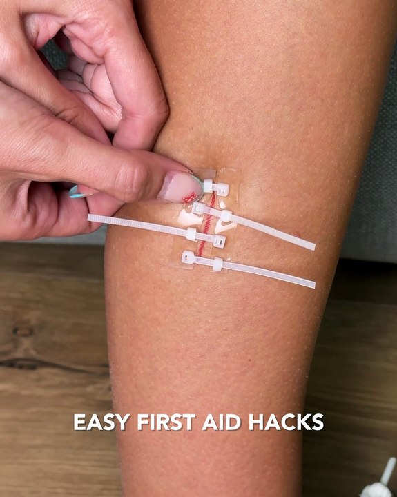 Helpful first aid hacks