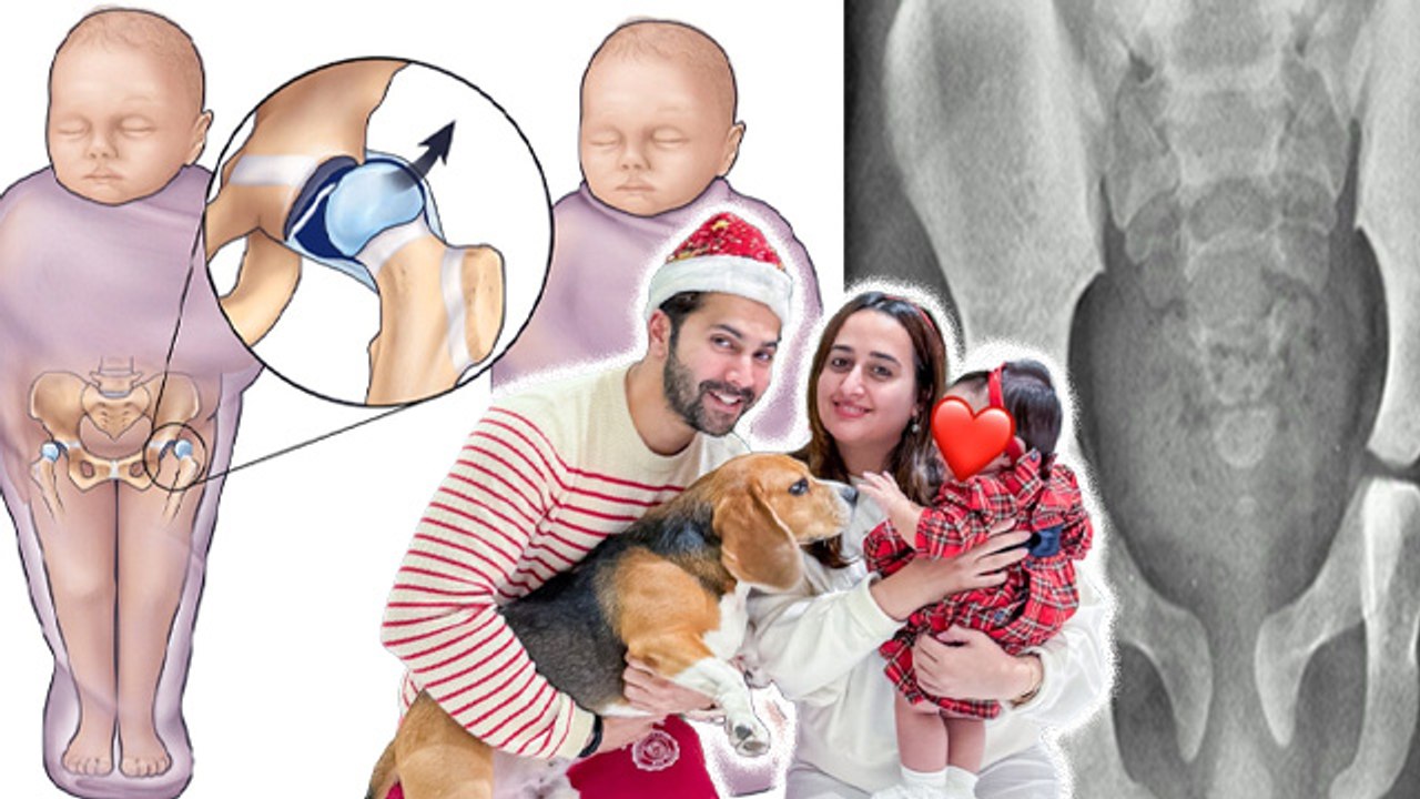 Varun Dhawan Daughter Disease: Hip Developmental Dysplasia क्या है, Reason, Symptoms and Treatment