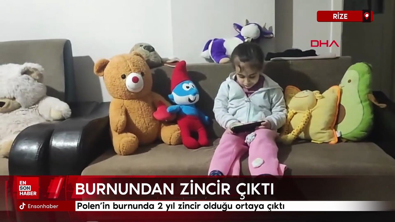 5 yaşındaki Polen, 2 yıldır burnunda tırnak makası zinciriyle yaşamış