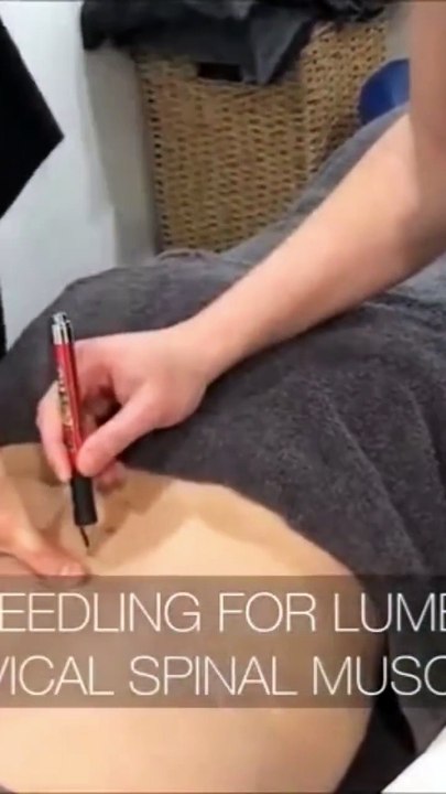 "The Precision Reset: How the Dry Needling Method Melts Muscle Knots #Recovery"