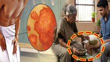 Jangh Me Daad Ka Ilaj: जांघ में दाद क्यों होता है,इलाज क्या है | Thigh Ringworm Treatment |Boldsky