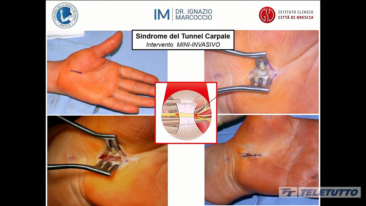 Obiettivo salute - Chirurgia della mano