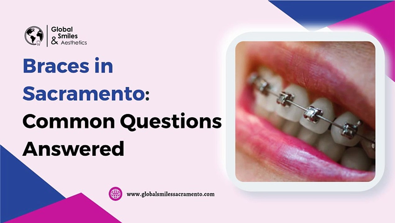 Braces in Sacramento Common Questions Answered
