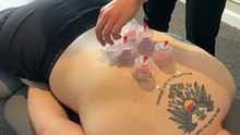 Medical cupping therapy method