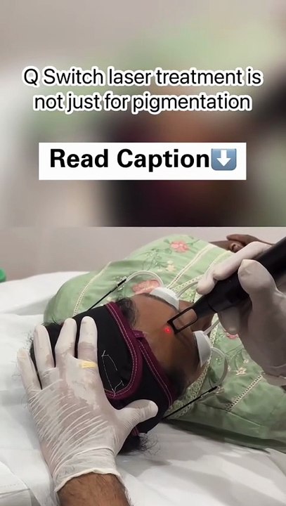 Q switch laser treatment is not just for pigmentation | Epiderma Skin and Hair Clinic Jayanagar