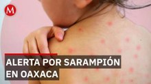 Reportan 32 casos confirmados de sarampión en menores de edad en Oaxaca