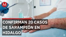 Secretaría de Salud confirma 20 contagios de sarampión en Hidalgo