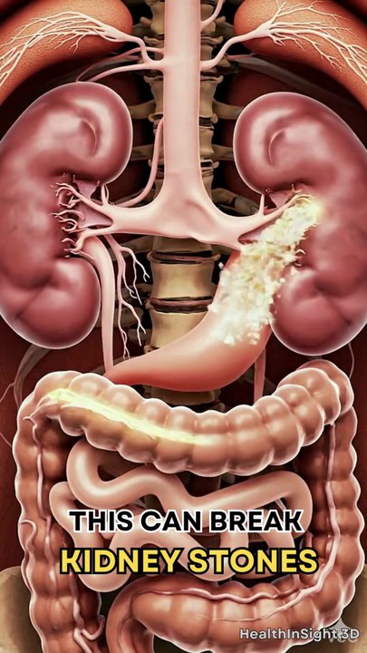 Top 3 Drinks That Help Remove Kidney Stones Fast