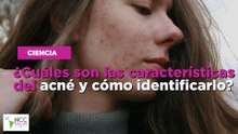 ¿Cuáles son las características del acné y cómo identificarlo?