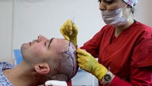 Inside Turkey's $2B hair transplant tourism boom