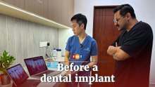 What really happens before a dental implant