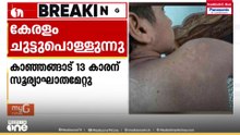 ചുട്ടുപൊള്ളി കേരളം... കാഞ്ഞങ്ങാടിൽ 13 വയസുകാരന് സൂര്യാഘാതമേറ്റു