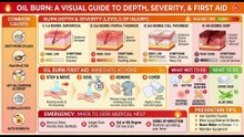 Skin Burn  First Aid Advice